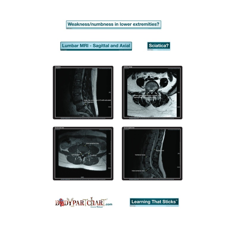 Body Part Chart:  Lumbar MRI Sagittal and Axial        –   Removable     Adhesive Decal