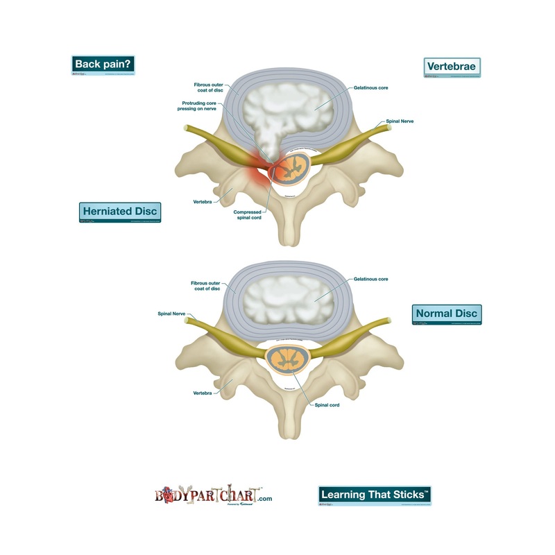 Body Part Chart:  Prolapsed Disc        –   Removable     Adhesive Decal